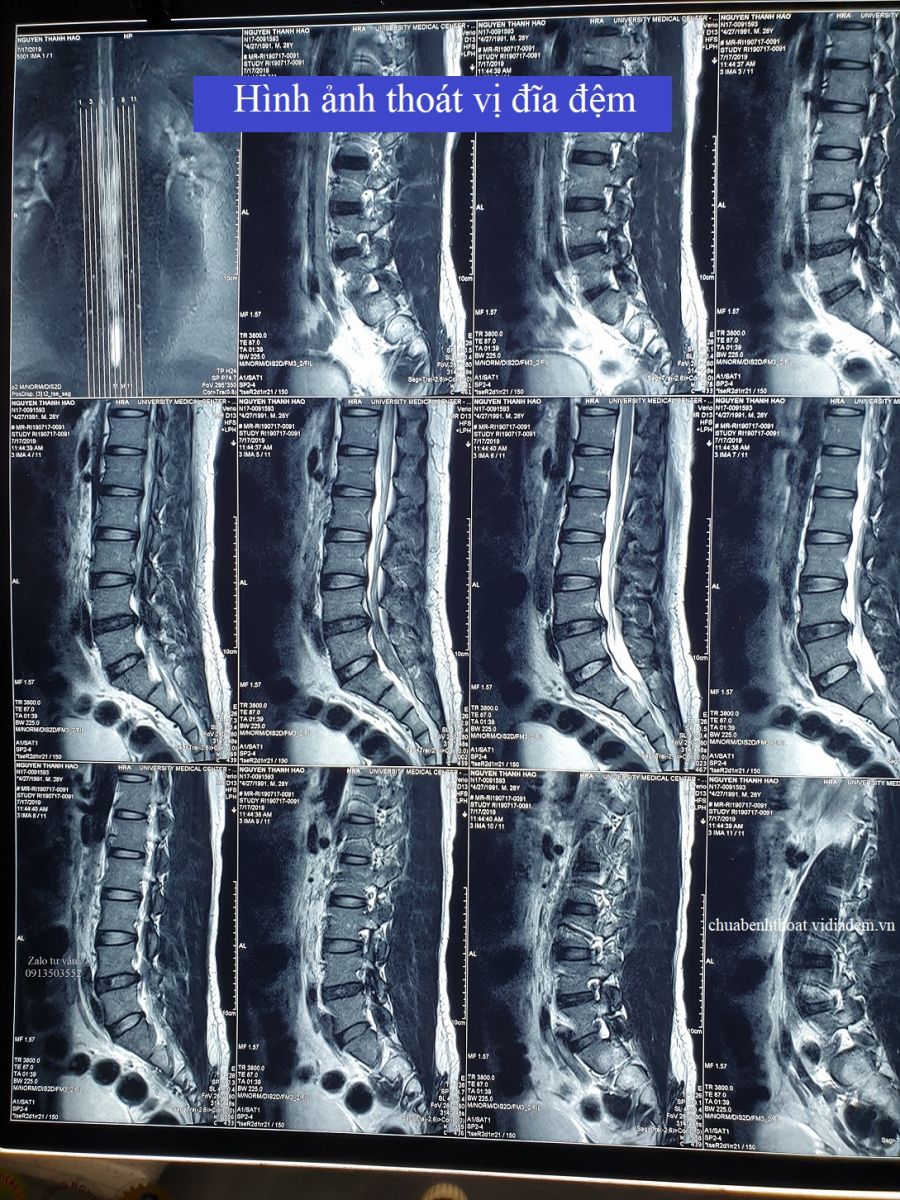 Hình ảnh thoát vị đĩa đệm